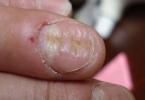 Виды дистрофии ногтей больших пальцев ног Распространенные виды деформаций