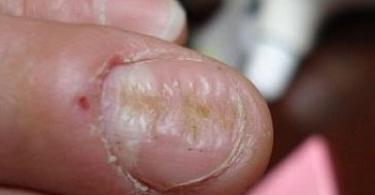 Виды дистрофии ногтей больших пальцев ног Распространенные виды деформаций